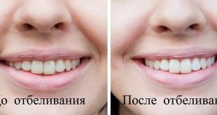 суть отбеливания зубов