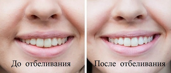 суть отбеливания зубов